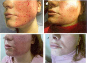 Stages of skin repair after a partial resection