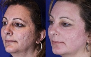 Laser partial rejuvenation before and after photos