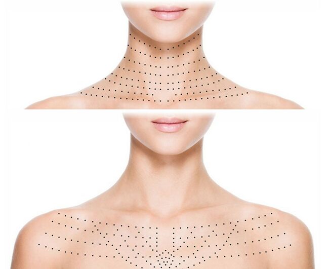 Skin marking on the neck and décolleté to rejuvenate biorevitalization