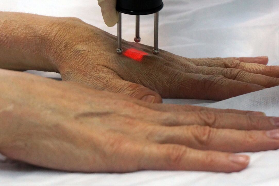 Non-ablative Laser Rejuvenation of Hands