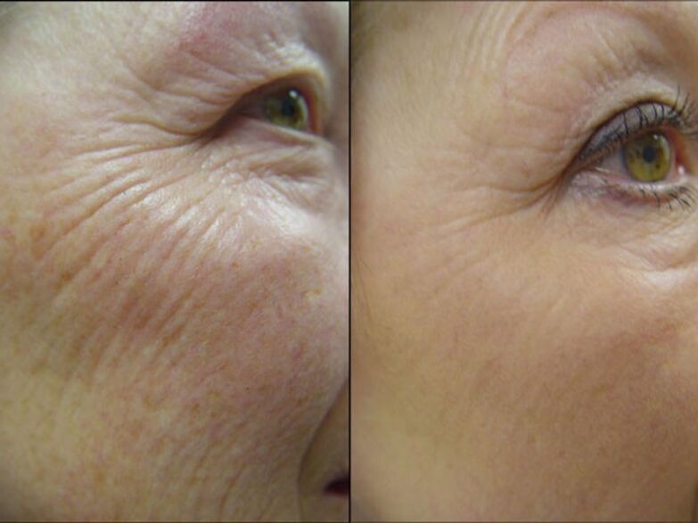 Before and after laser rejuvenation procedure - significant reduction in wrinkles