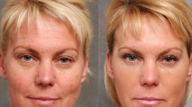 Before and after the rejuvenation process