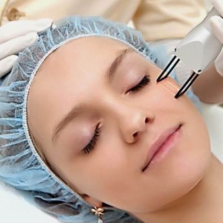 Laser partial rejuvenation